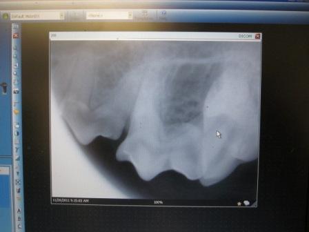 Dental Digital X-ray